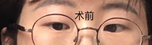 宁波眼科医院郁琪华医生全切双眼皮手术案例