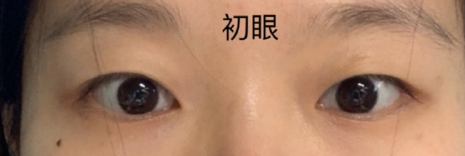 杭州黛雅(黛颜)陆新医生全切双眼皮案例