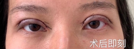 上海九院黄筱琳双眼皮去皮去脂手术案例