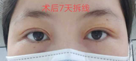 长沙欣颜田毅医生双眼皮提肌+开内眼角经验分享