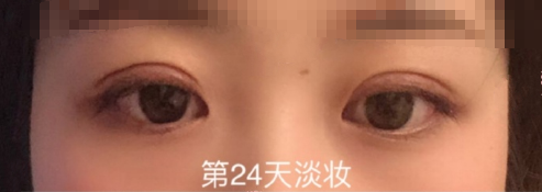 武汉华科大同济医学院陈平医生精切双眼皮案例