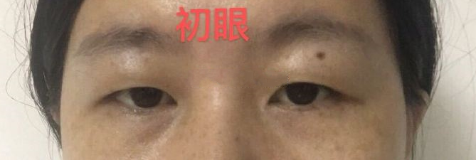 面诊了尹琳、卢建建、唐晓军,双眼皮哪个好?