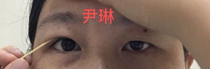 面诊了尹琳、卢建建、唐晓军,双眼皮哪个好?