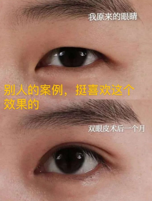 面诊了尹琳、卢建建、唐晓军,双眼皮哪个好?