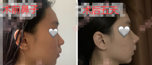北京八大处王欢全肋鼻部手术手术案例