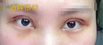 长沙彭青和院长青和医疗美容双眼皮+开眼角案例