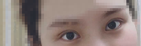 长沙彭青和院长青和医疗美容双眼皮+开眼角案例