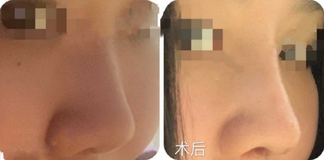 上海素颜美医学美容蹇洪膨体+肋骨鼻部手术案例
