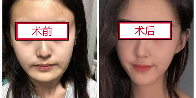 八大处张智勇下颌骨环切加颏成型术怎么样?案