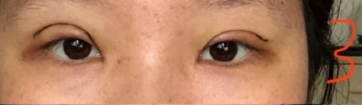 上海九院陆阳医生全切双眼皮(倒睫)案例