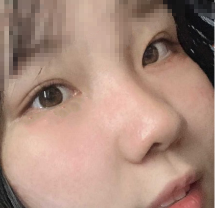 上海九院陆阳医生全切双眼皮(倒睫)案例