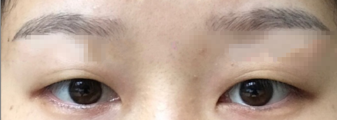武汉卓美整形王海平医生双眼皮全切案例