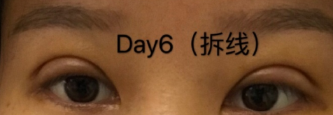 武汉卓美整形王海平医生双眼皮全切案例