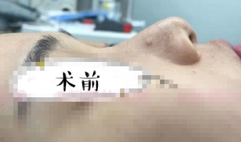 广州爱来医疗美容王宏伟医生膨体耳软骨隆鼻