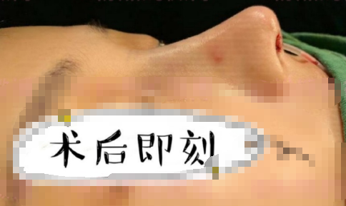 广州爱来医疗美容王宏伟医生膨体耳软骨隆鼻