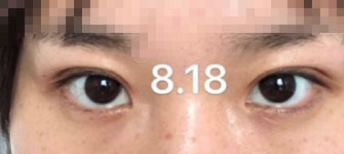 上海九院毕晓萍全切双眼皮左眼去皮案例