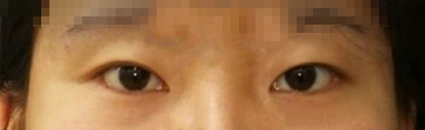 河北医科大学附属第二医院张洁双眼皮开眼角