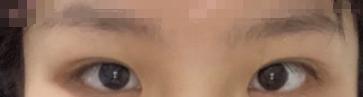 天津美莱田忠健医生精细全切双眼皮开眼角案例