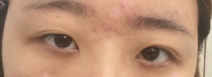 成都良好美研一徐彬医生全切双眼皮手术案例