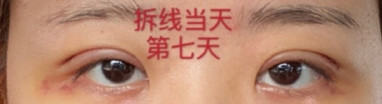 成都良好美研一徐彬医生全切双眼皮手术案例