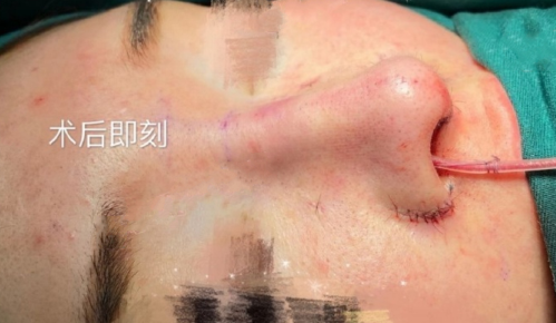 宁波珈禾整形张智棋医生肋骨+膨体隆鼻案例