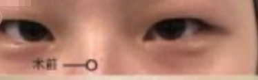 上海九院张路医生全切双眼皮(加提肌)