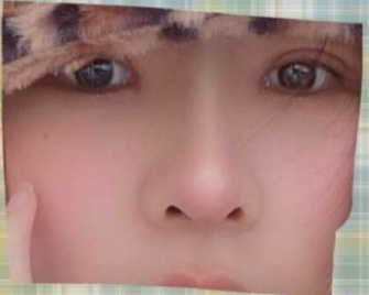 武汉协和医院钟爱梅半肋硅胶鼻部手术+全切双眼皮