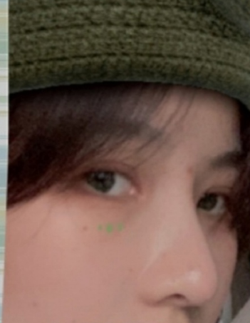 武汉协和医院钟爱梅半肋硅胶鼻部手术+全切双眼皮