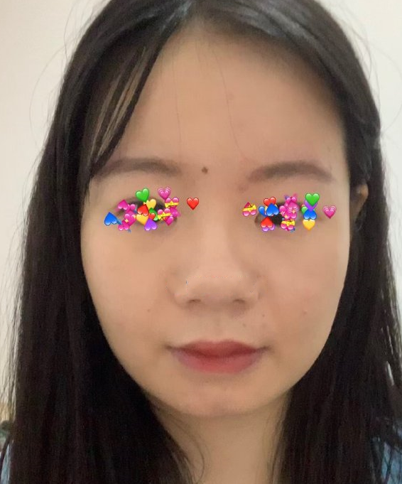 觉得鼻子很大怎么改良比较好?