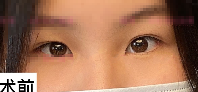 上海九院范海燕医生全切双眼皮+开内眼角案例