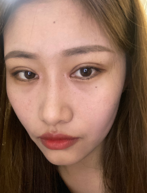 第一中心医院刘文礼医生全切双眼皮+开眼角案