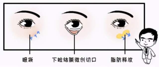北京画美丽都眶隔释放技术怎么样?案例|点评
