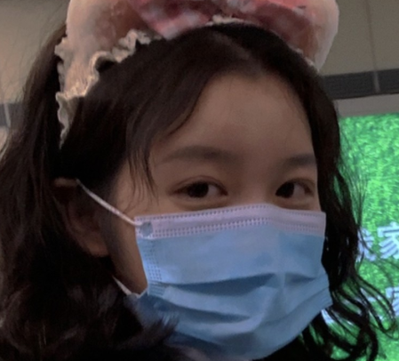 西安医学院第二附属医院粟娜做双眼皮怎么样?