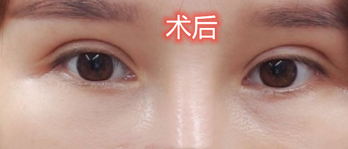 北京画美丽都眶隔释放技术怎么样?案例|点评