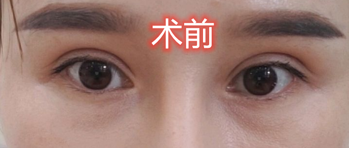 北京画美丽都眶隔释放技术怎么样?案例|点评
