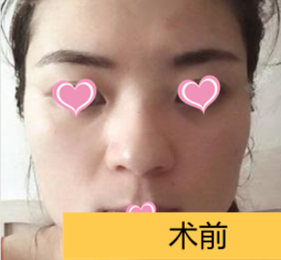 北京杨斌双颌矫正技术怎么样?案例|点评
