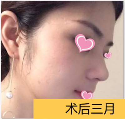 北京杨斌双颌矫正技术怎么样?案例|点评