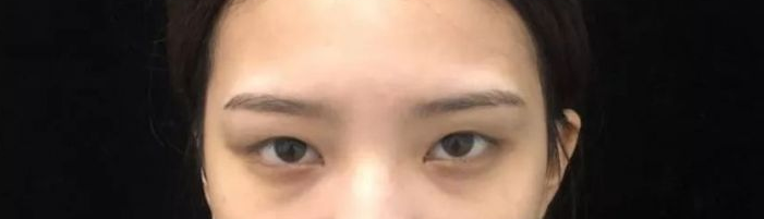 九院的李瑾双眼皮技术怎么样?案例|点评