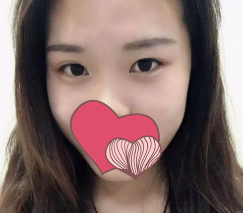 诺德王志云双眼皮技怎么样?案例|点评