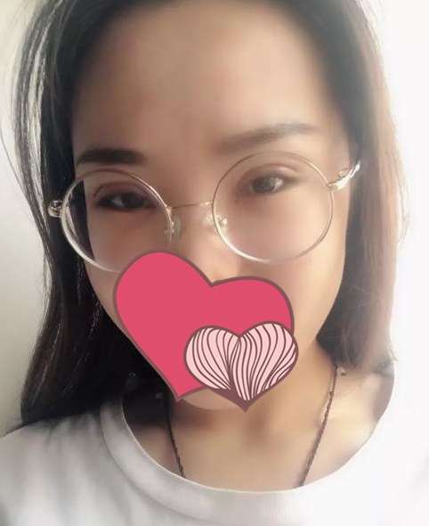 诺德王志云双眼皮技怎么样?案例|点评