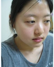 大连瑞丽刘畅、美琳达李娇蕾做双眼皮谁更好?