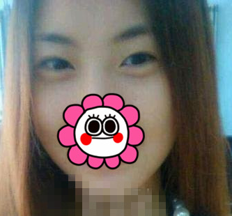 大连瑞丽刘畅、美琳达李娇蕾做双眼皮谁更好?