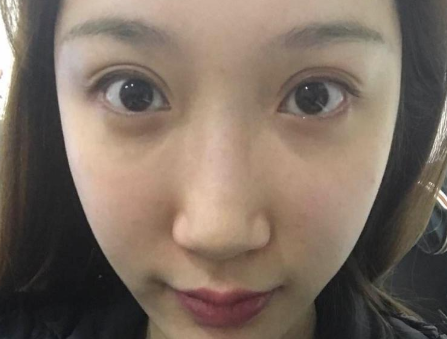 大连美天张井忠、爱德丽格刘志刚双眼皮谁好?