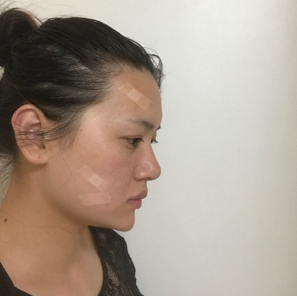 天津南开欧菲整形美容医院自体脂肪全脸填充