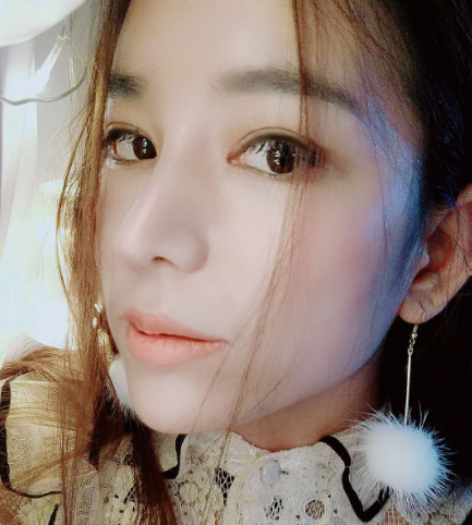 北京蕾士悦医美医生李海兵双眼皮、鼻部手术案例