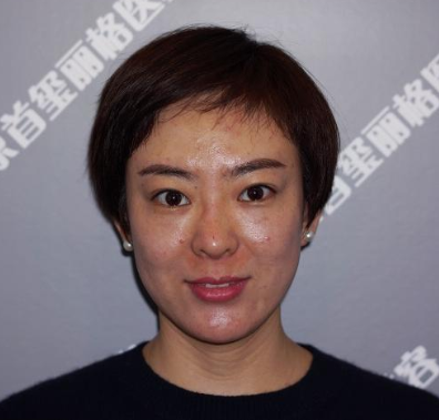 北京首玺丽格医美医生韩胜埋线提升提升案例！
