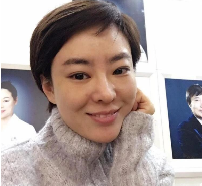 北京首玺丽格医美医生韩胜埋线提升提升案例！