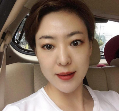 北京首玺丽格医美医生韩胜埋线提升提升案例！