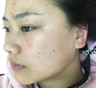 成都美诗沁医疗美容注射瘦脸案例分享！