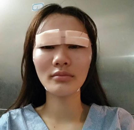【双眼皮案例】广东美恩整形切开双眼皮果